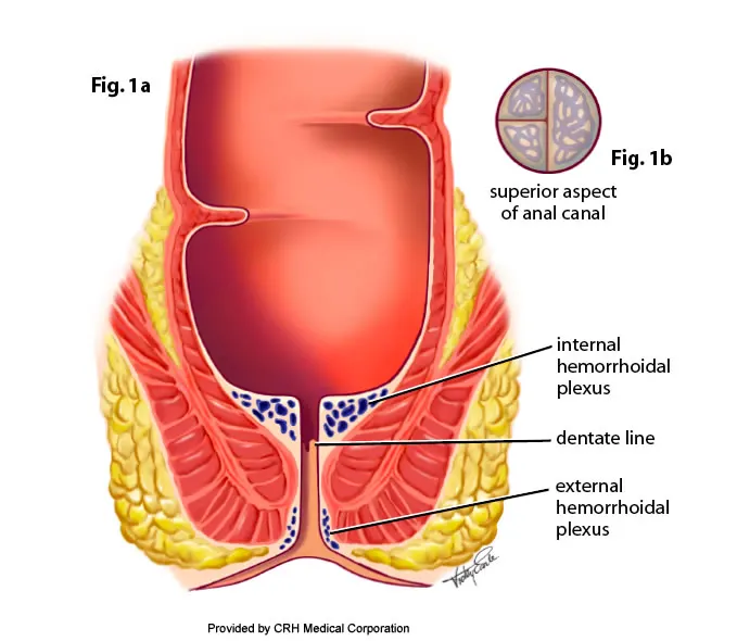 how to get rid of hemorrhoids without surgery